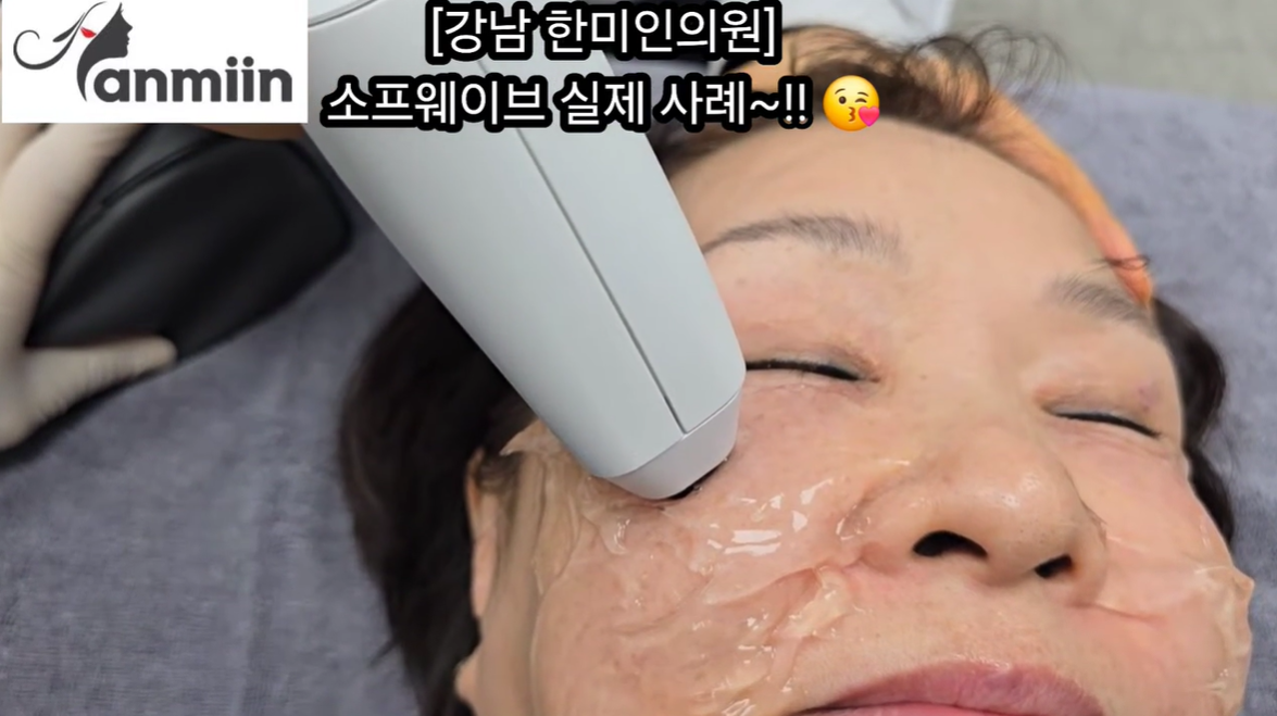 Sofwave 시술